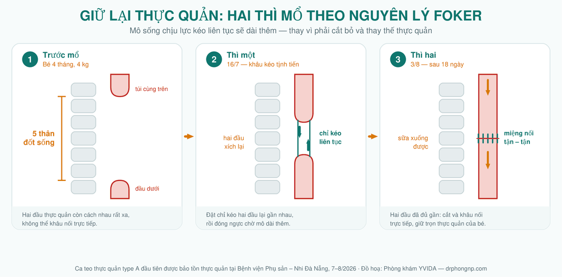 Sơ đồ hai thì mổ bảo tồn thực quản theo nguyên lý Foker: khoảng cách 5 đốt sống, khâu kéo tịnh tiến, nối tận tận
